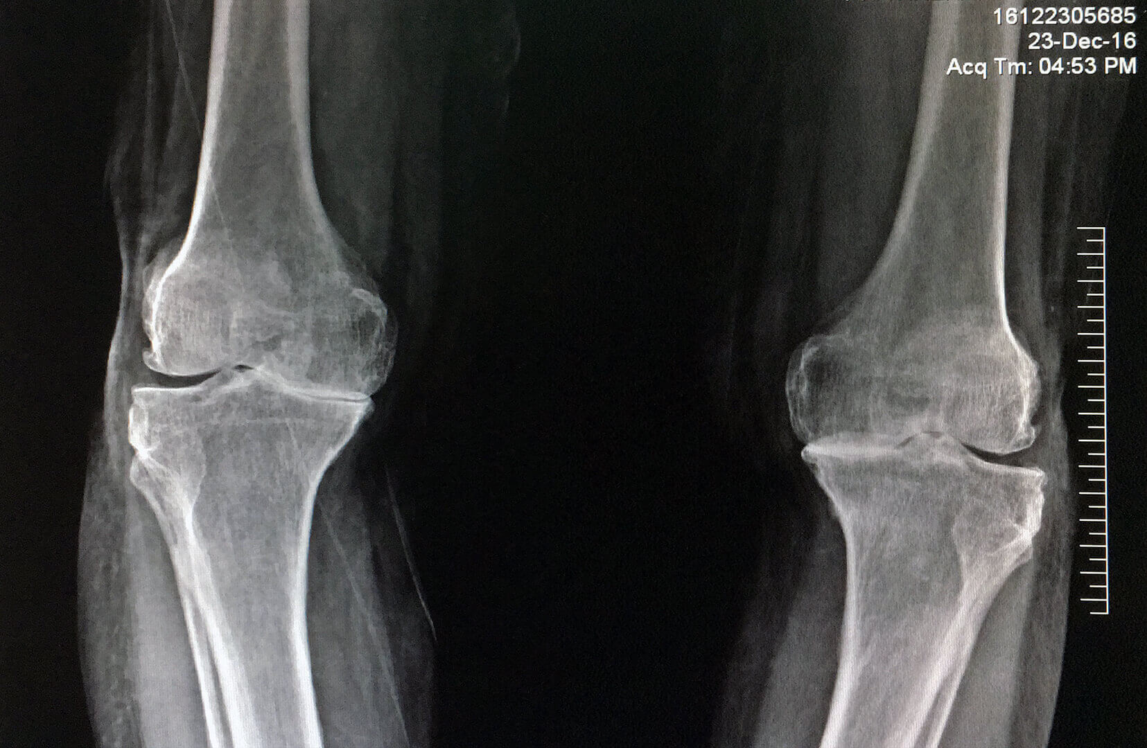 Total Knee Replacement in Ahmedabad, Gujarat, Jivraj Park, Satellite